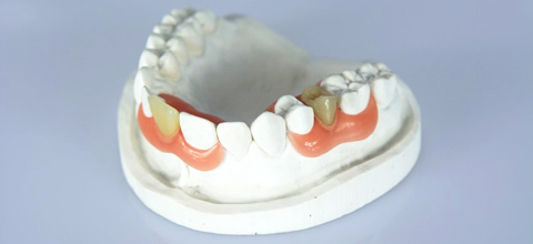 ノンクラスプデンチャー