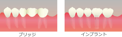 インプラントとブリッジの比較